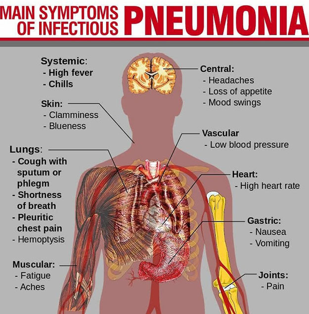 Pneumonia | Indonesia Re