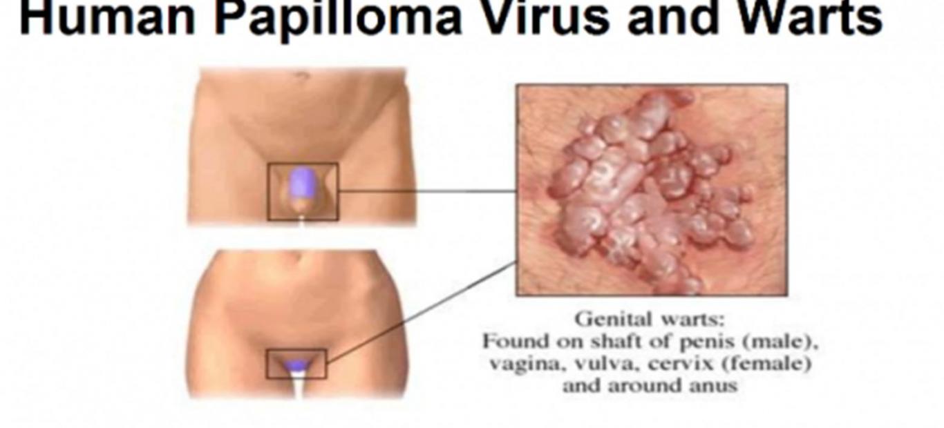 Virusul HPV - toate detaliile pe care ar trebui să le cunoască orice femeie. • Halmasan