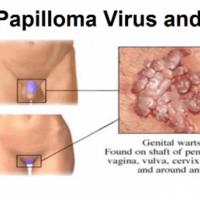 Infeksi HPV | Indonesia Re
